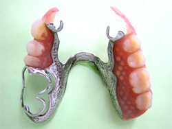 義歯の一例
