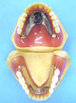 総義歯の一例